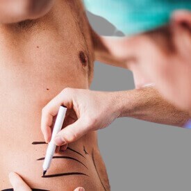 Liposuction